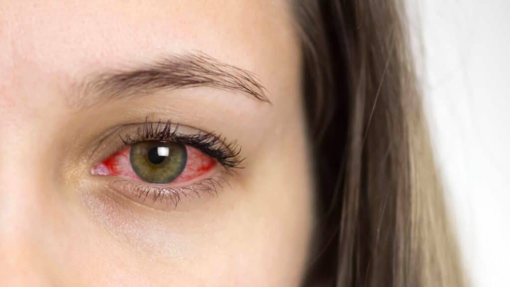 THC, de psychoactieve stof in marihuana, veroorzaakt rode ogen.