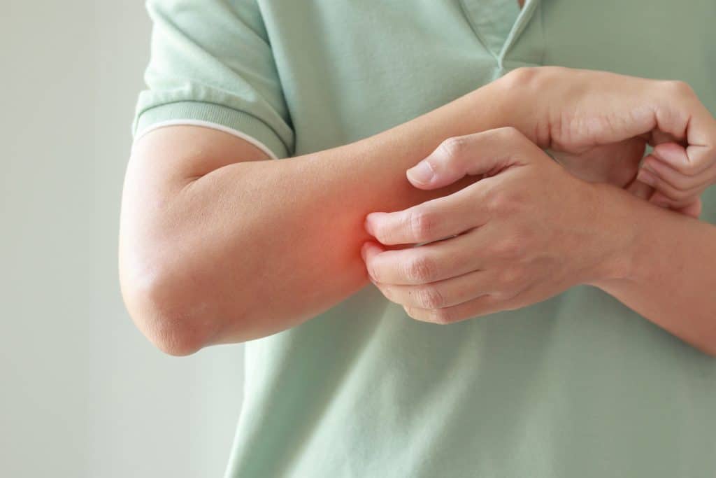 Young Asian Man Itching And Scratching On Arm From Allergic Itchy Dry Skin Eczema Dermatitis Insect Bites