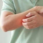 Young Asian Man Itching And Scratching On Arm From Allergic Itchy Dry Skin Eczema Dermatitis Insect Bites